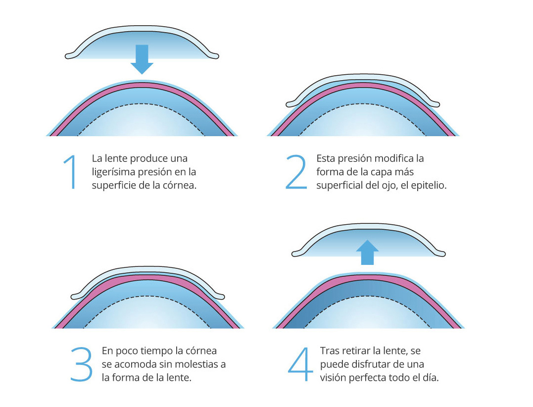 Imagen de lentillas orto-k